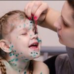 Вітряна віспа (вітрянка) – перші ознаки та питання щодо лікування Вітряна віспа (вітрянка) – перші ознаки та питання щодо лікування
