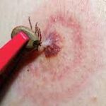 ПАМ'ЯТКА  Хвороба Лайма (Бореліоз)